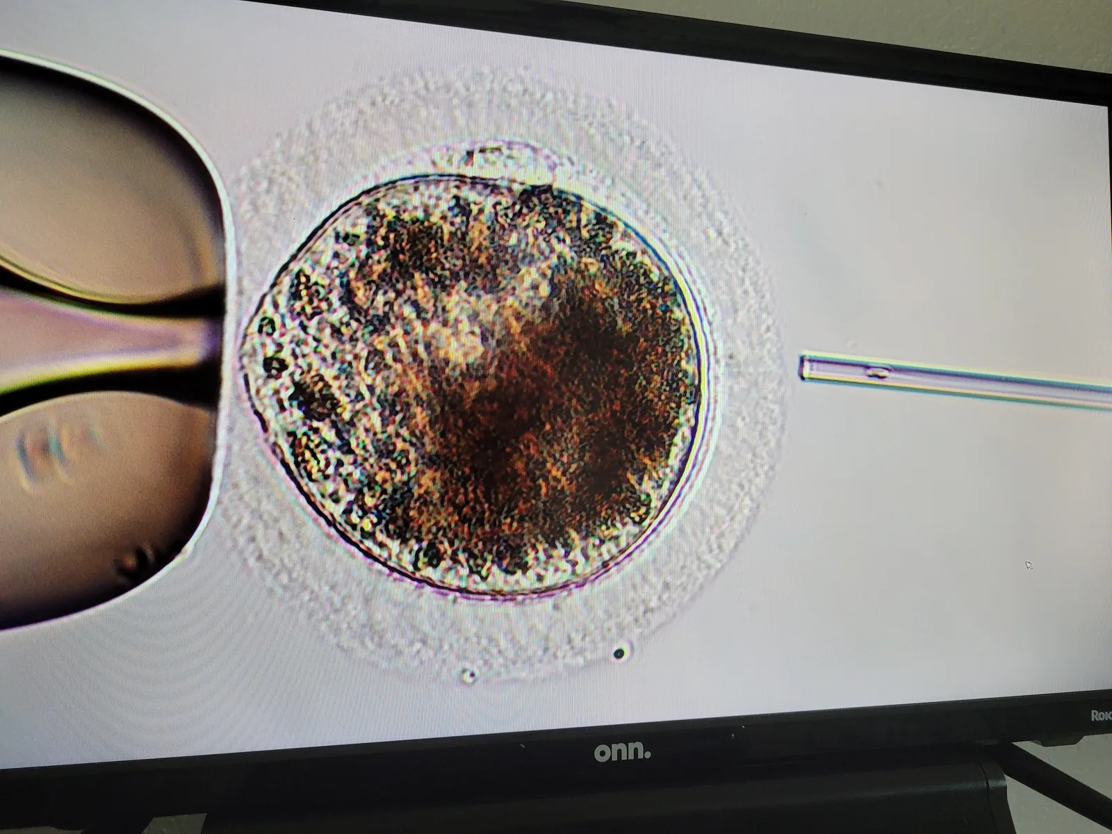 ICSI in progress — the oocyte is held steady on the left while a single sperm is injected from the right.