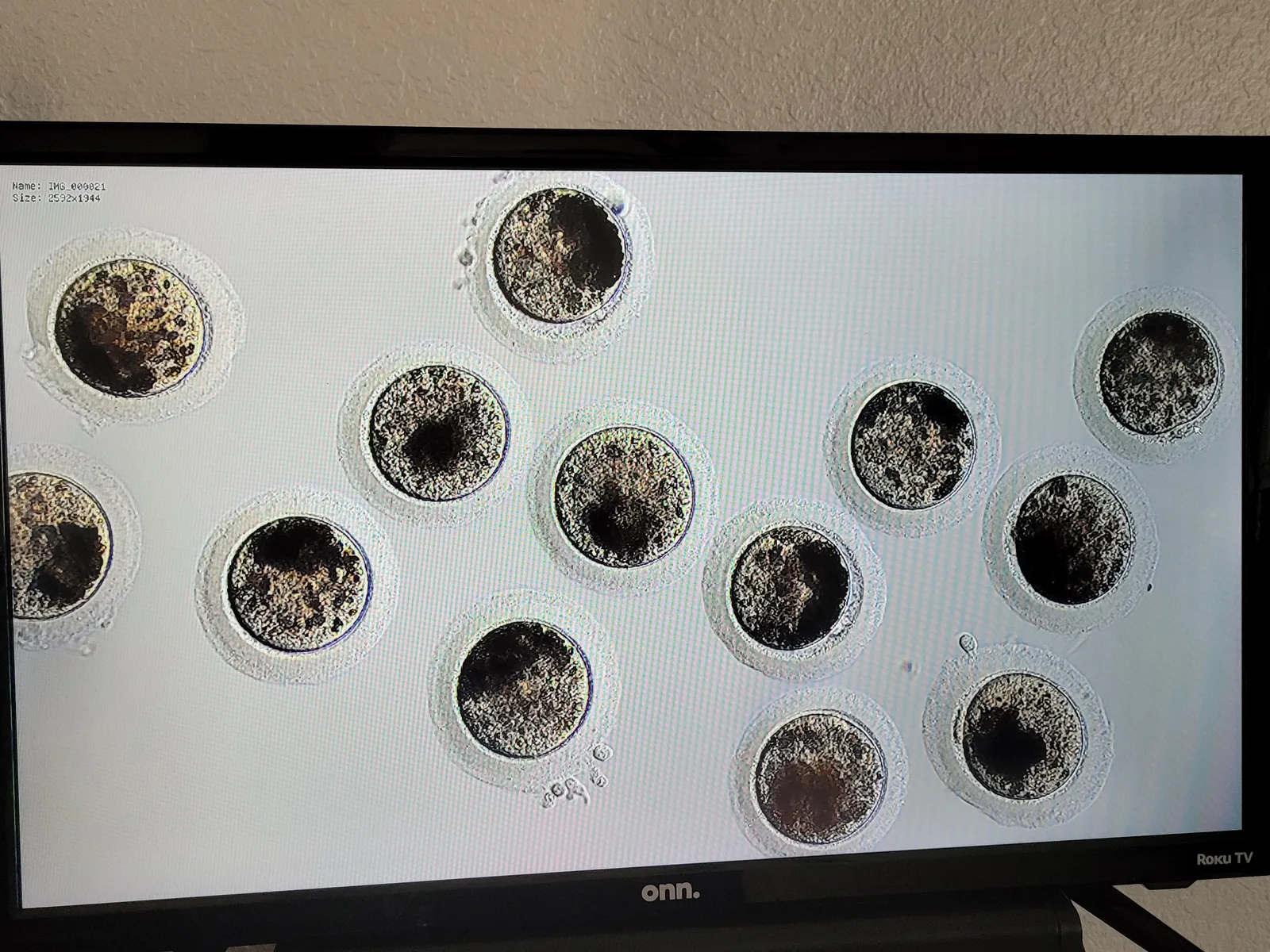 Oocytes in culture. Not every one will mature, and not every mature oocyte will go on to produce a transferable embryo.