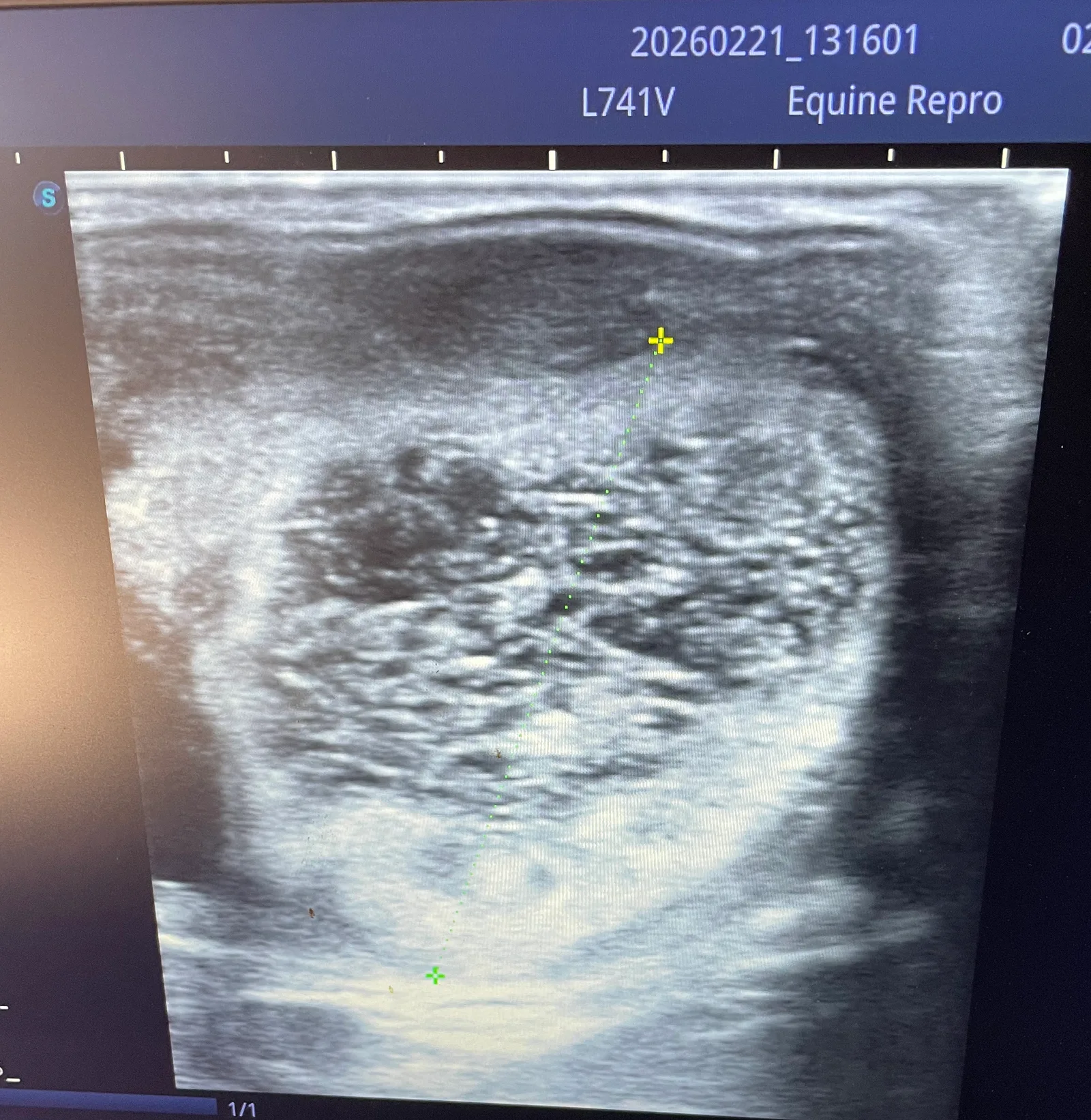 After ovulation a corpus luteum will form in the ovary.