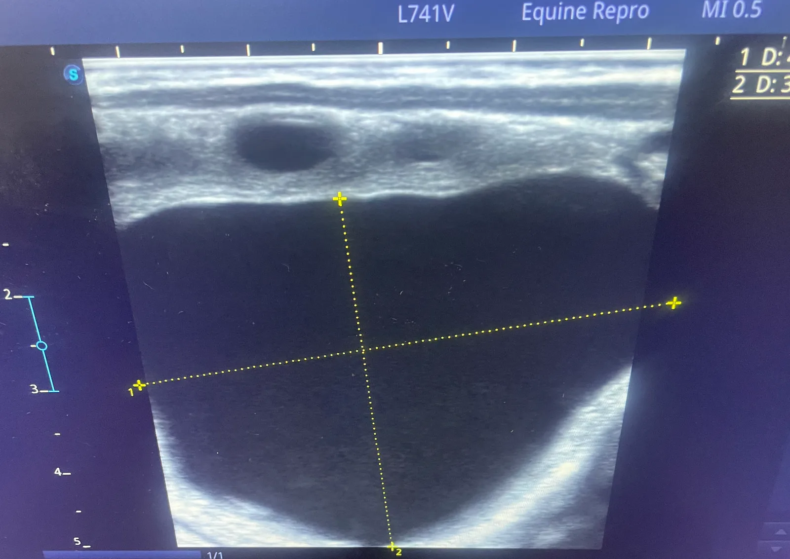 Moving closer to ovulation, the follicle will get softer and more irregular in shape.